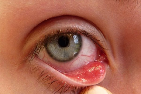 Bệnh đau mắt hột (Nhiễm trùng mắt) Bệnh đau mắt hột (Nhiễm trùng mắt)